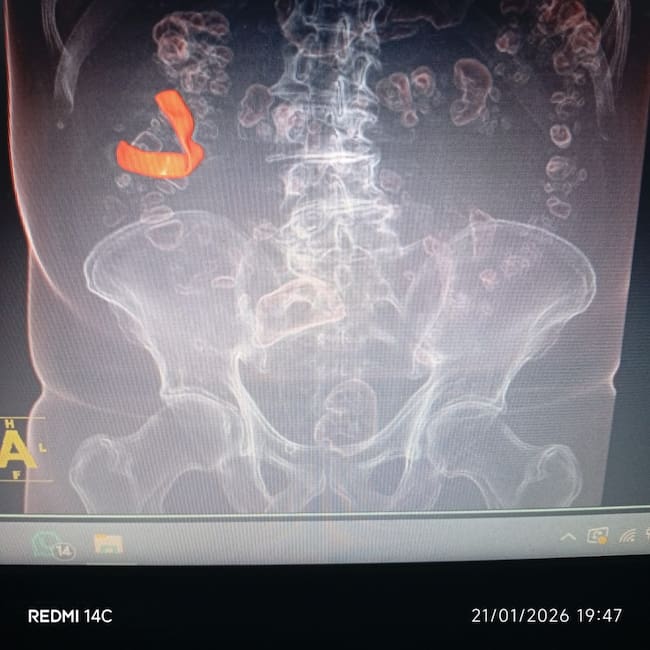 El hallazgo se produjo tras exámenes realizados en 2025, luego de años de molestias abdominales persistentes.