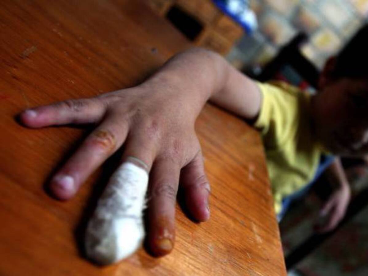 En el Quindío siete padres de familia han sido sancionados porque sus hijos resultaron quemados con pólvora