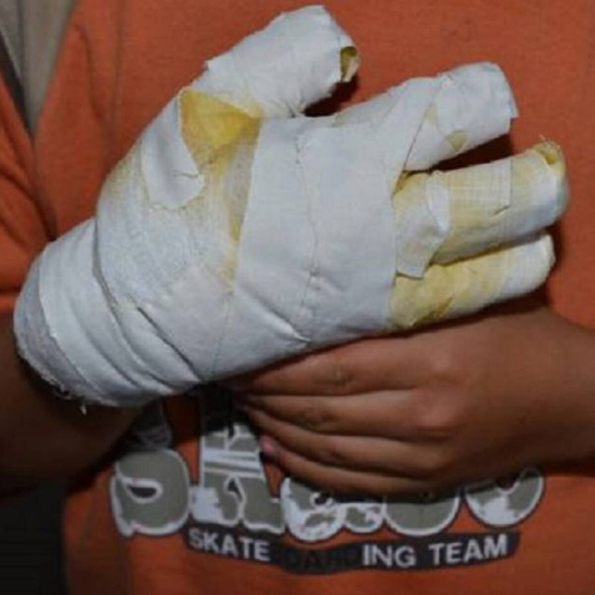 Dos menores y un adulto resultaron con quemaduras con pólvora tras noche de Navidad