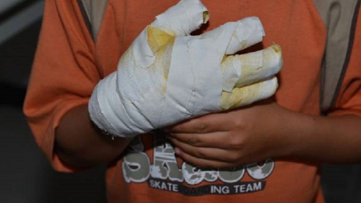 Cuatro quemados por pólvora dejó la alborada del 1 de diciembre en el Valle