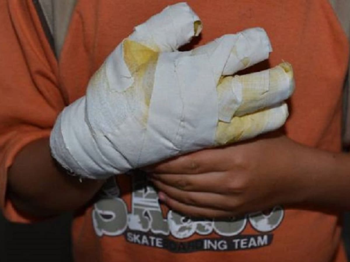 Primer niño quemado con pólvora en el Tolima