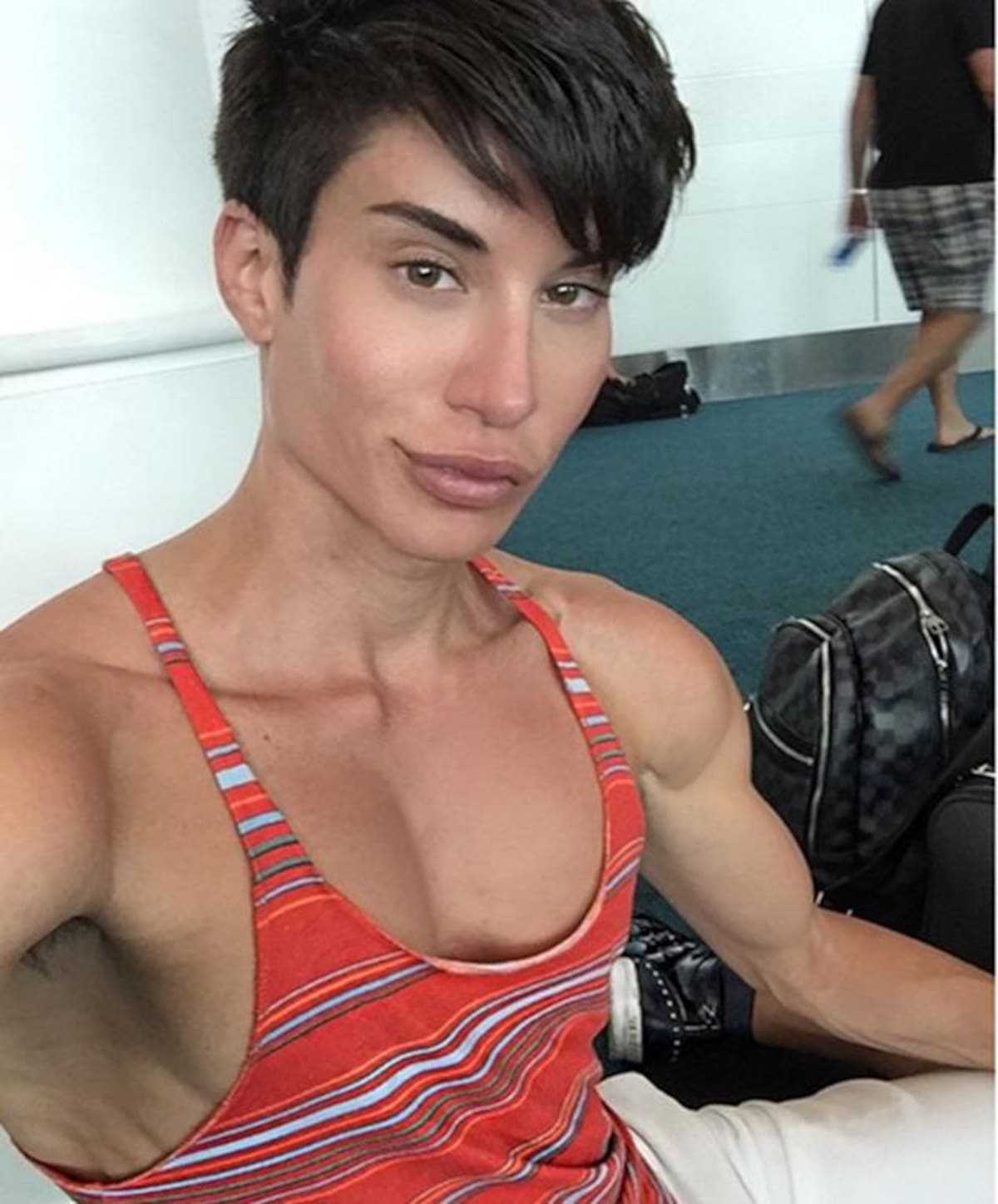 Justin Jedlica se operó para remover tres venas de su frente, intervención que lo pudo dejar ciego. Fotos: Instagram.
