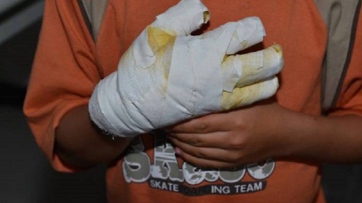 Cali registra el primer quemado por el uso indebido de pólvora