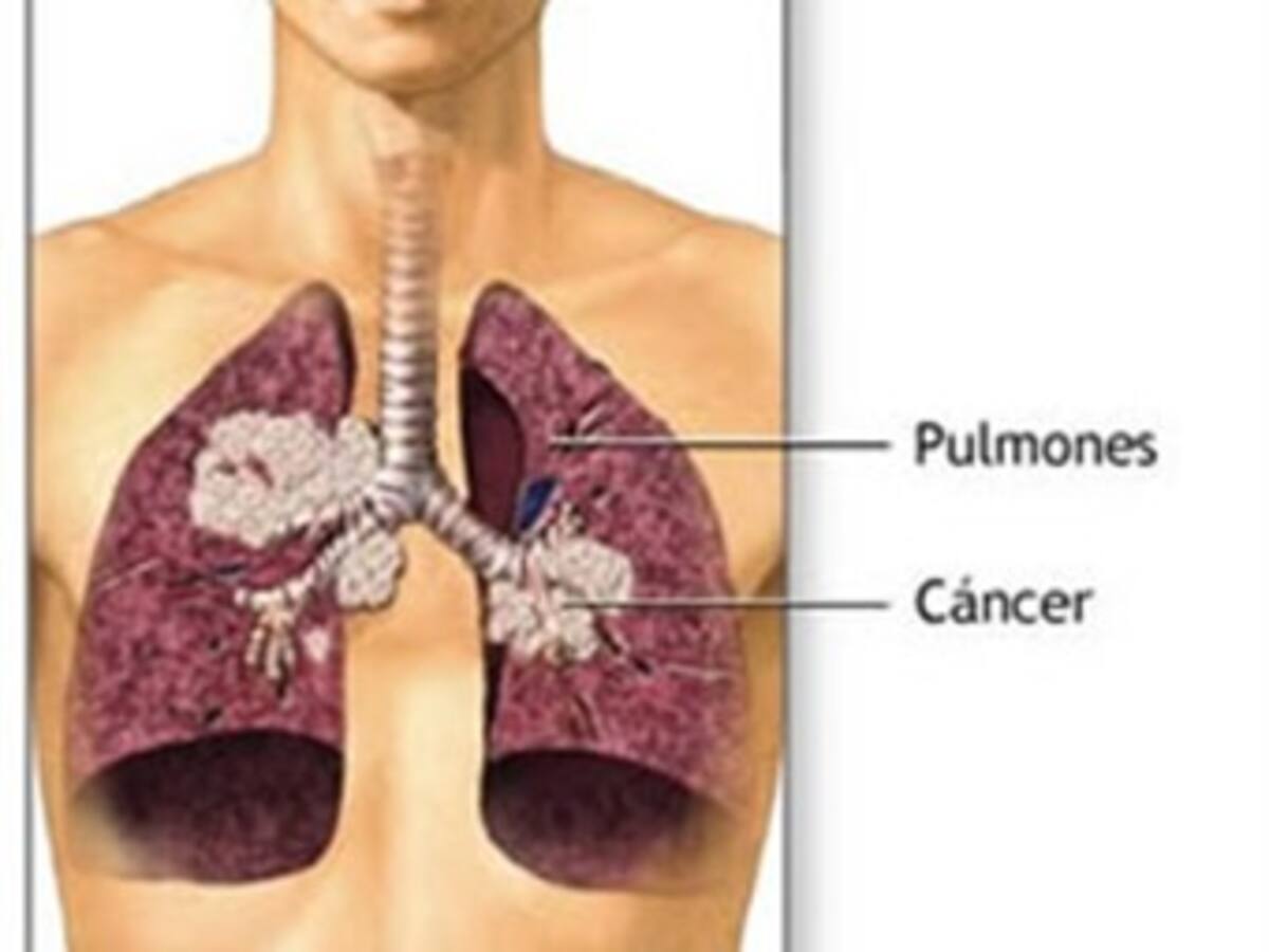 Un test de orina podría indicar el riesgo de padecer cáncer de pulmón
