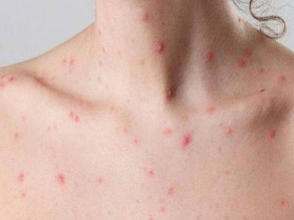 Lo que debe saber de la viruela del mono