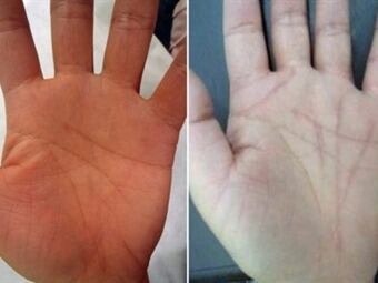 Antes y despúes de la polémica cirugía. Foto: www.thedailybeast.com