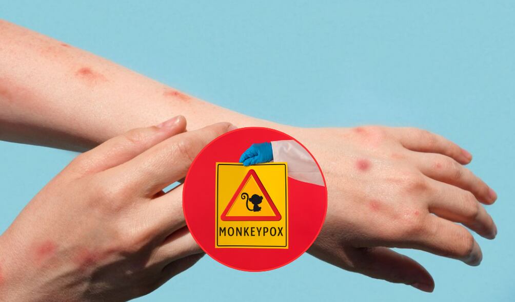 La OMS asegura que la viruela del mono no es el nuevo coronavirus porque se tiene más conocimiento sobre su transmisión, pero sobe todo hay vacunas. ( Foto: Getty / Caracol Radio )