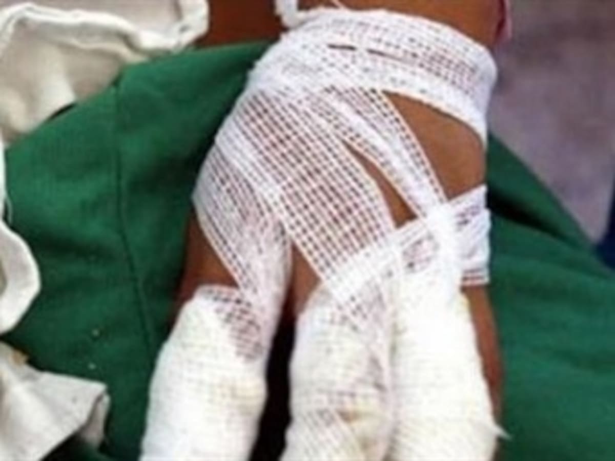 Una persona quemada en Quindío durante noche de velitas