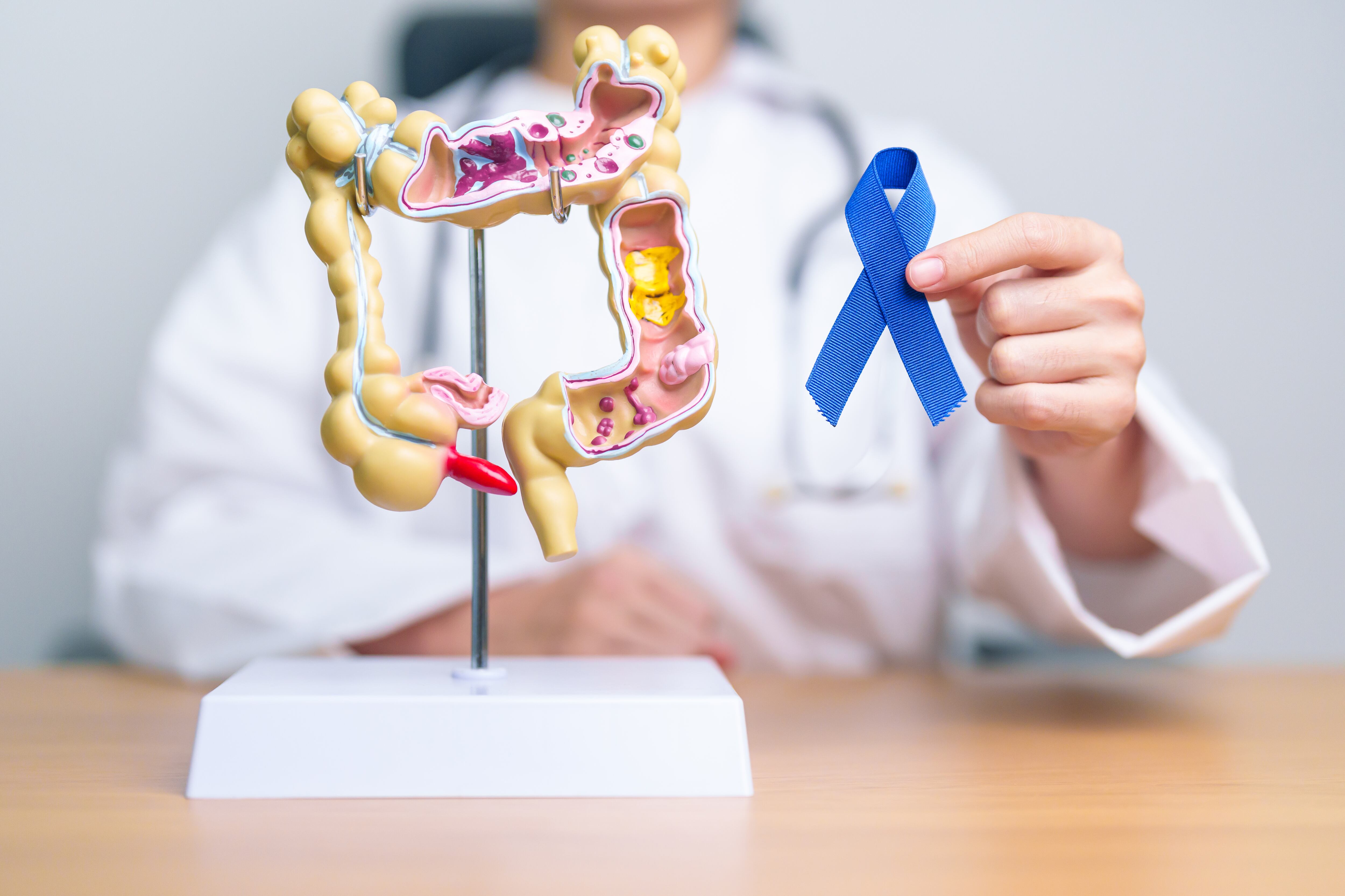 Cáncer de colon - Getty Images
