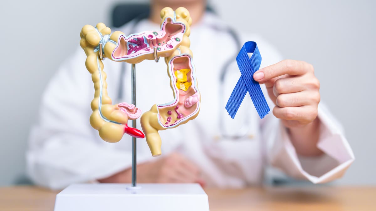 Cómo es el cáncer de colón: Síntomas con los que lo puede identificar, causa y tratamiento