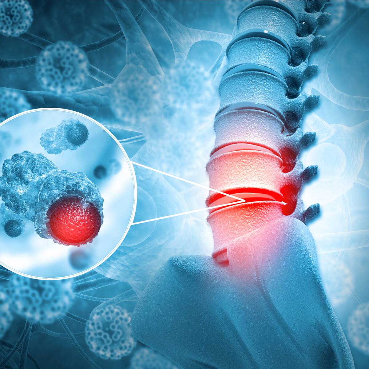 ¿Es hereditario? Así se manifiesta el dolor del cáncer en los huesos
