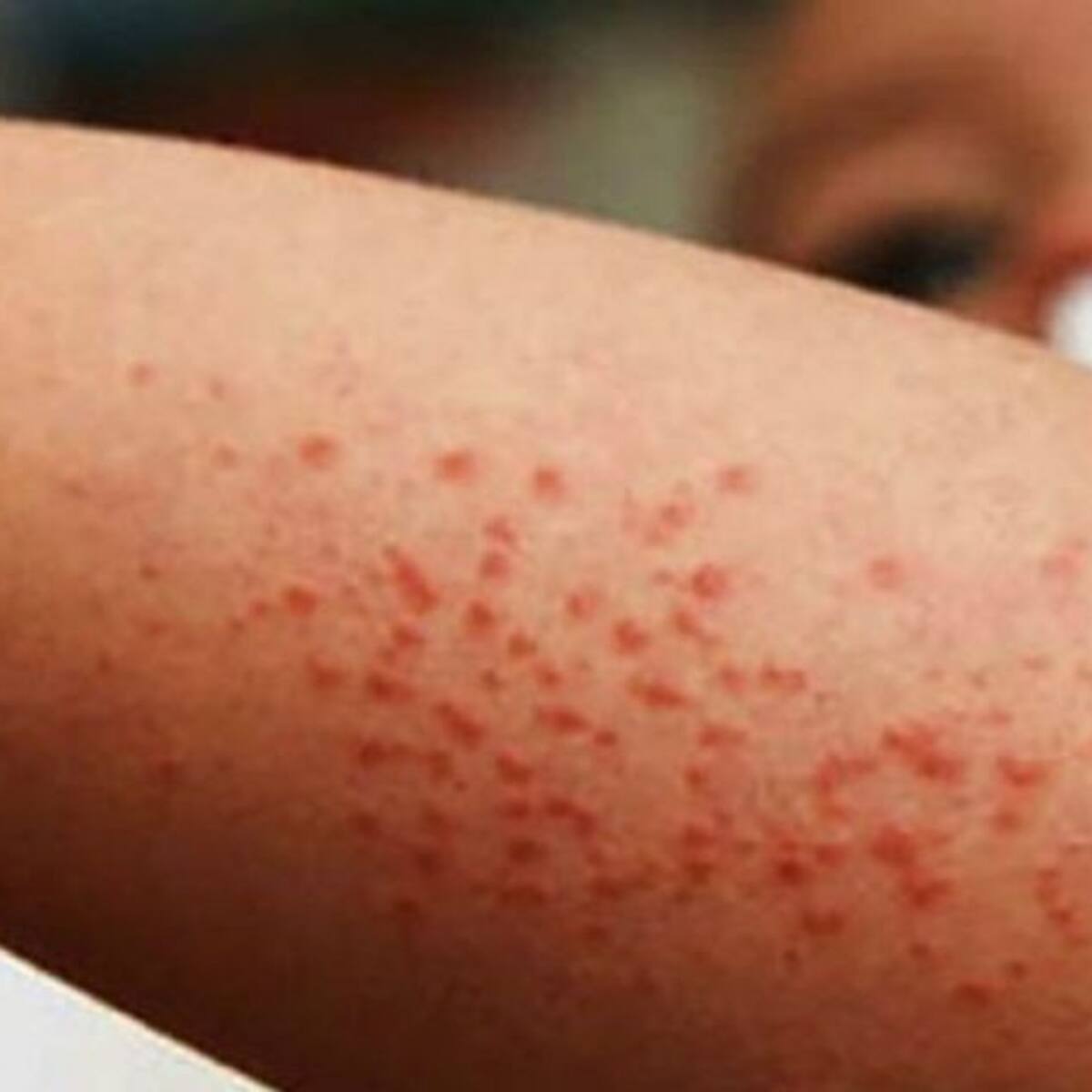 Sarampión: Panamá reforzará vigilancia ante aumento de casos en Costa Rica