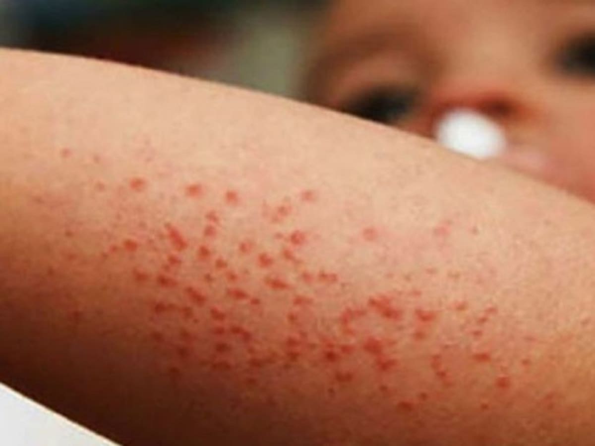 Sarampión: Panamá reforzará vigilancia ante aumento de casos en Costa Rica