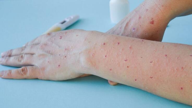 Ya van 51 casos de viruela del mono en Santander