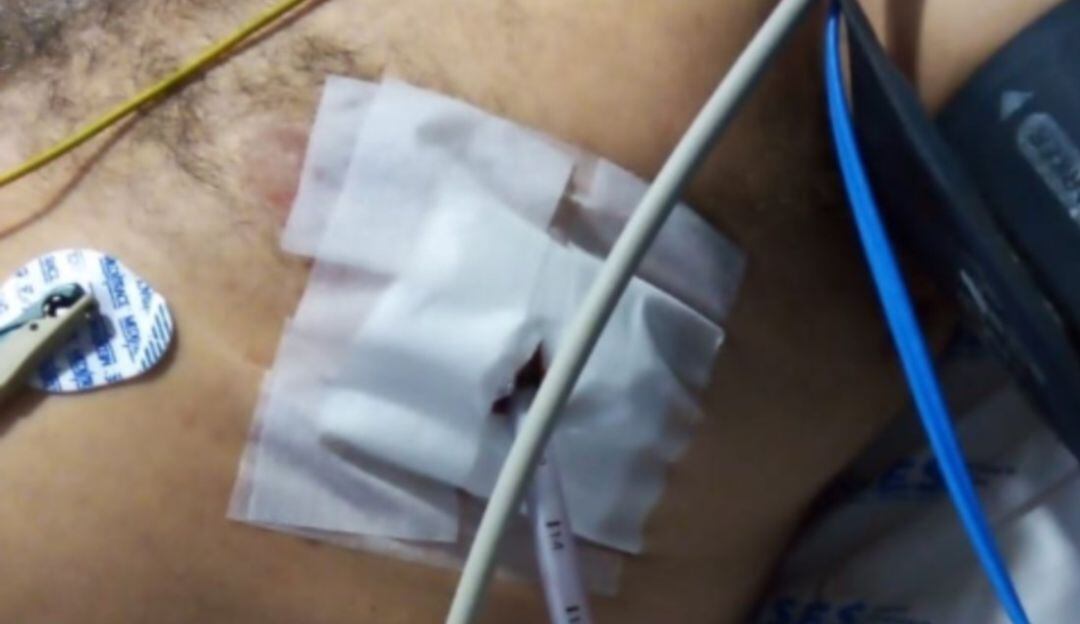 herida con arma cortopunzante