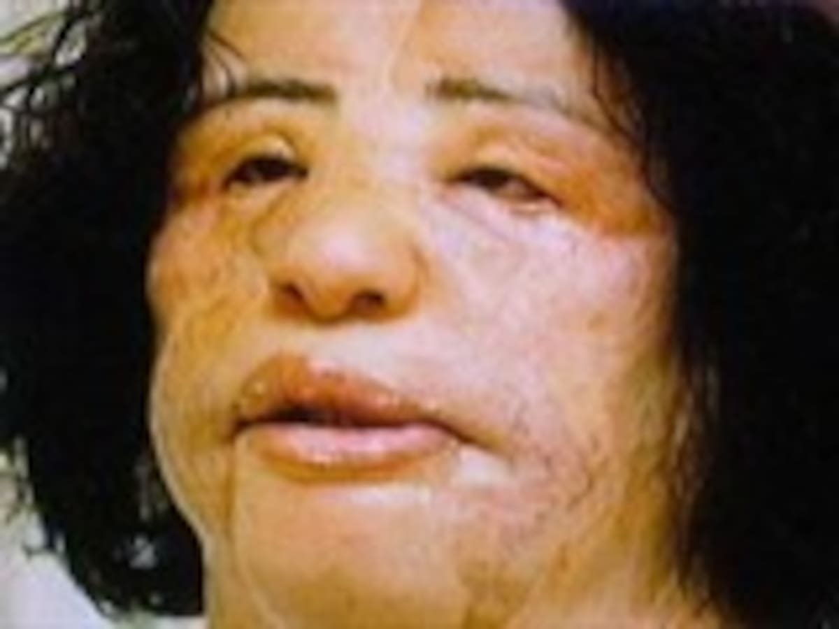 Una adicta a la cirugía estética se desfigura tras años de operaciones e inyectarse aceite