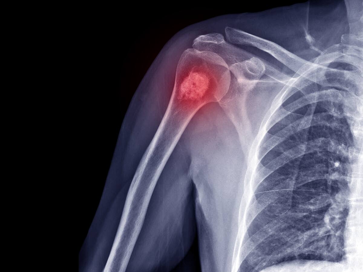 Síntomas y examen para detectar a tiempo el cáncer en los huesos