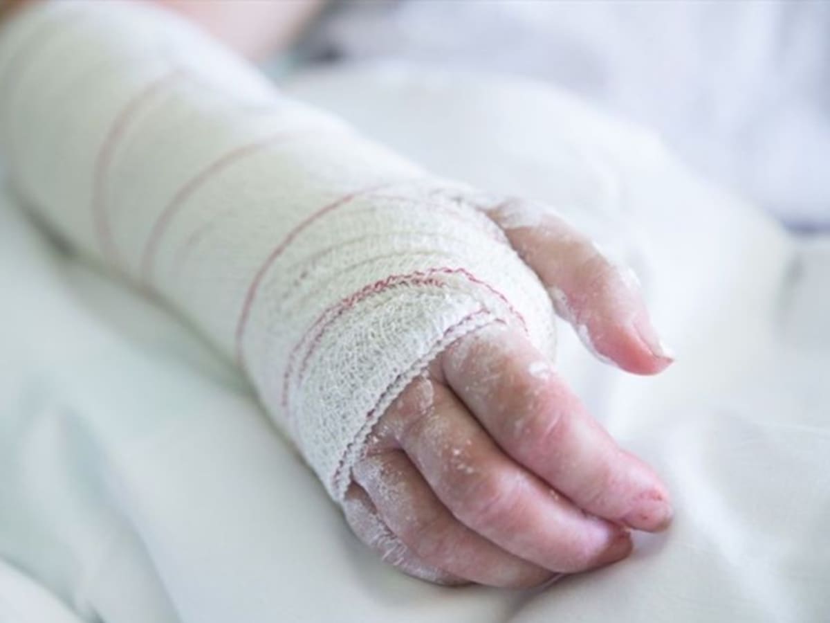 Otro hombre se quemó manipulando un taco en Pereira