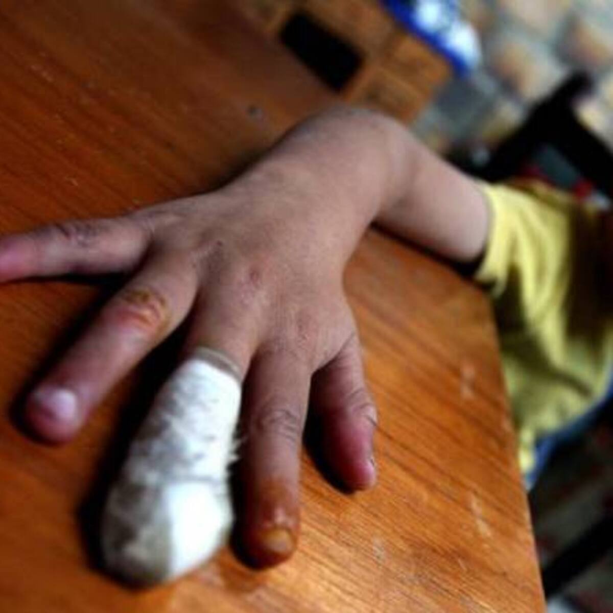 Niño de 8 años se quemó con pólvora en Puerto Boyacá