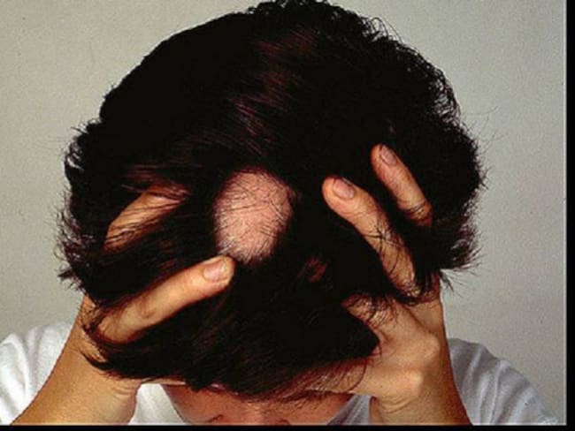 La Alopecia no es solo la caída del cabello