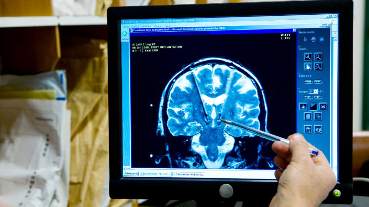 Implante cerebral ayudaría a que pacientes con esclerosis lateral recuperen el habla