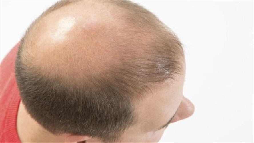 No hay cura para la calvicie, pero al menos ahora saben qué la produce.. Foto: Thinkstock