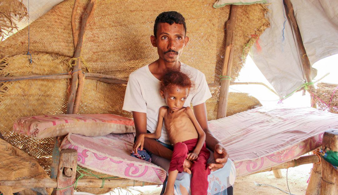 Padre e hijo afectados por desnutrición en Vietnam