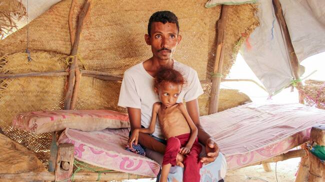 Padre e hijo afectados por desnutrición en Vietnam