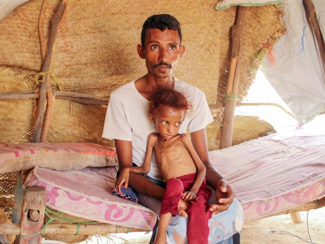 Padre e hijo afectados por desnutrición en Vietnam