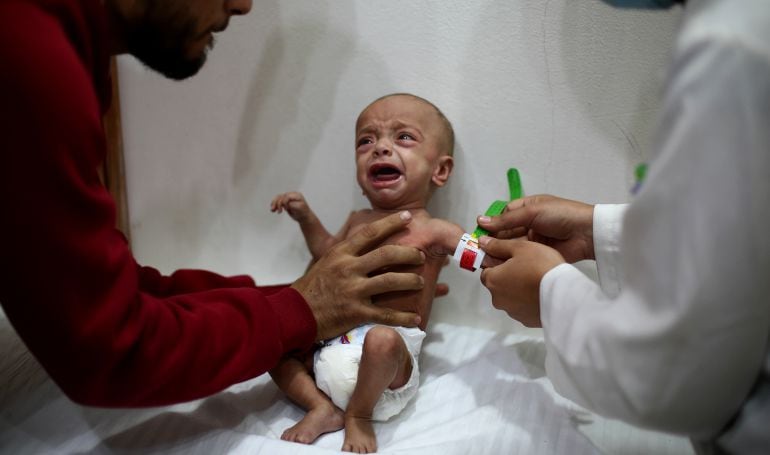 Desnutrición en Siria