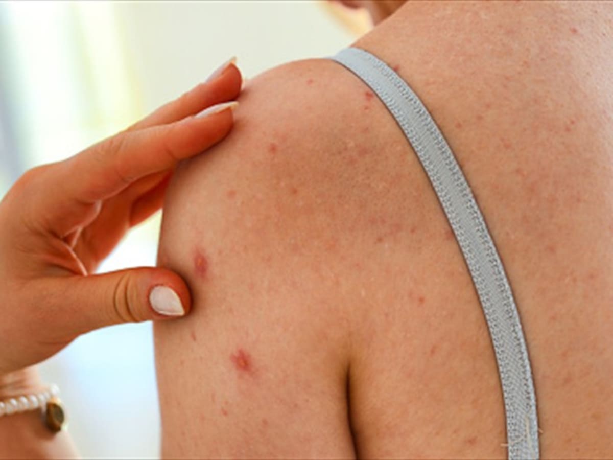 INS investiga brote de varicela en escuela ubicada en La Guajira