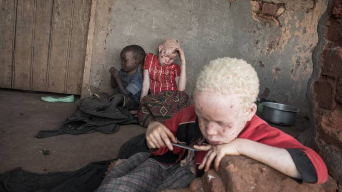 Aumenta en Mozambique el tráfico de huesos de niños albinos
