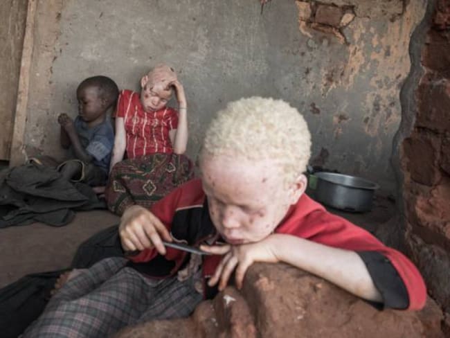 Aumenta en Mozambique el tráfico de huesos de niños albinos