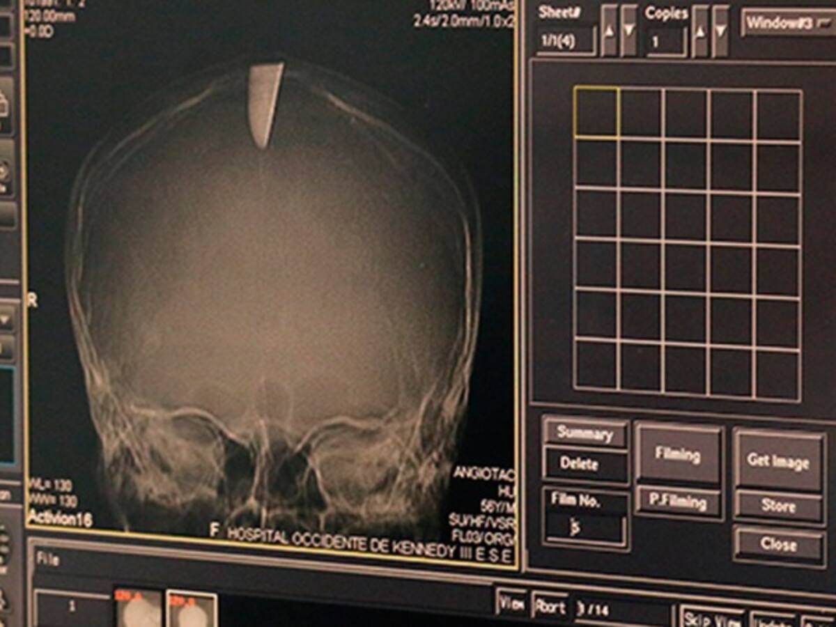 El hombre que caminó con un pedazo de cuchillo en su cerebro