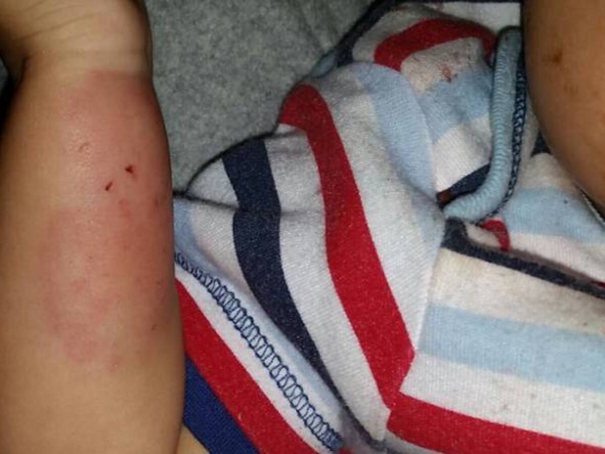 Bebé atacado a mordiscos por su padre en Bogotá no recibe protección del Estado