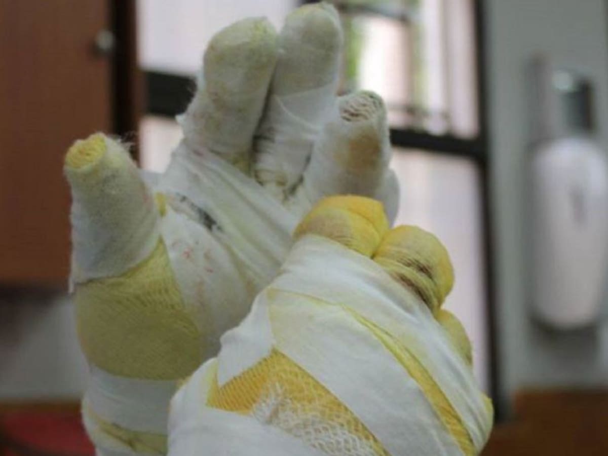 Ya son 30 los quemados por pólvora en el Valle: 14 son menores de edad