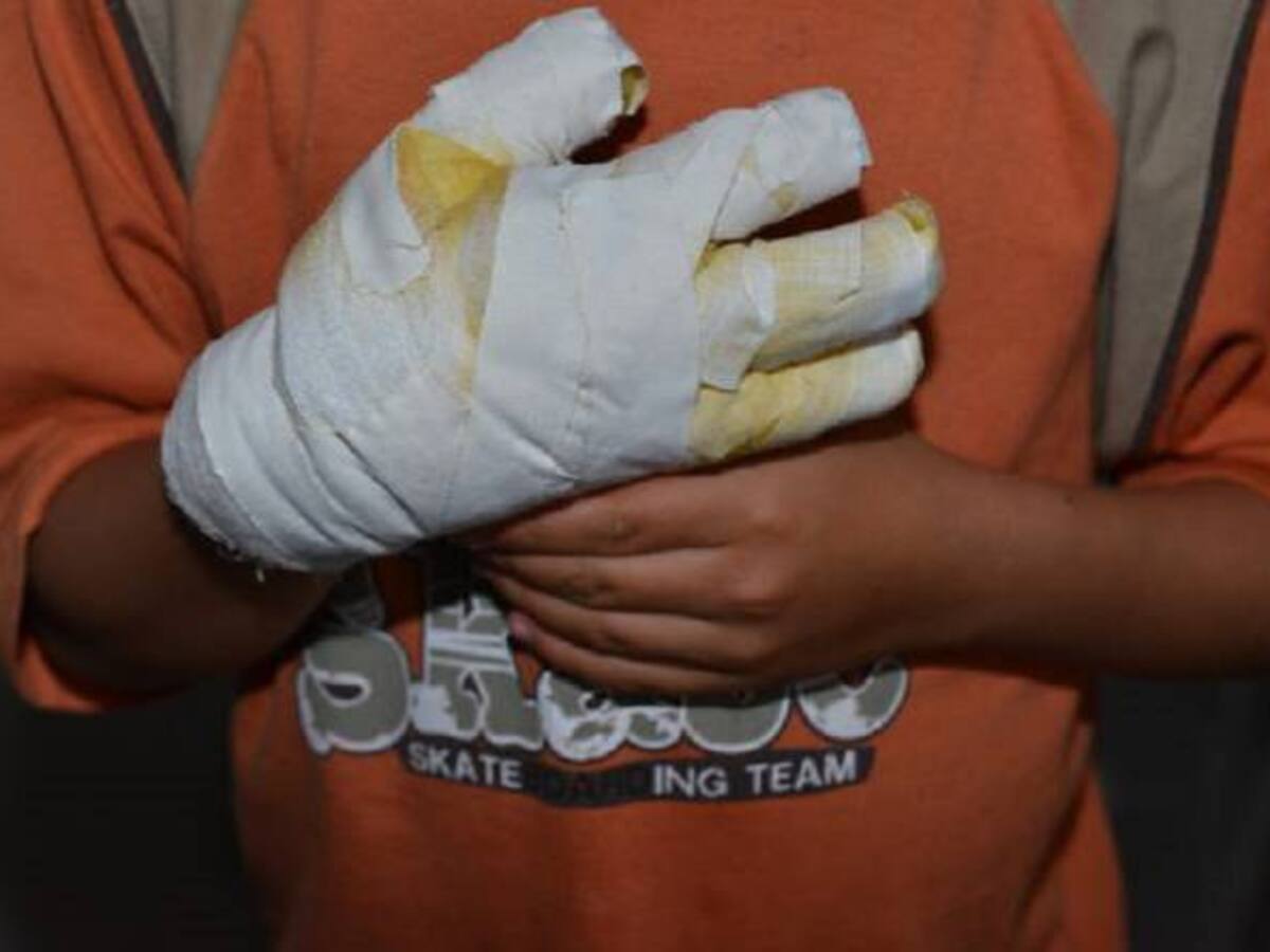 A 23 asciende el numero de quemados por pólvora en el Valle