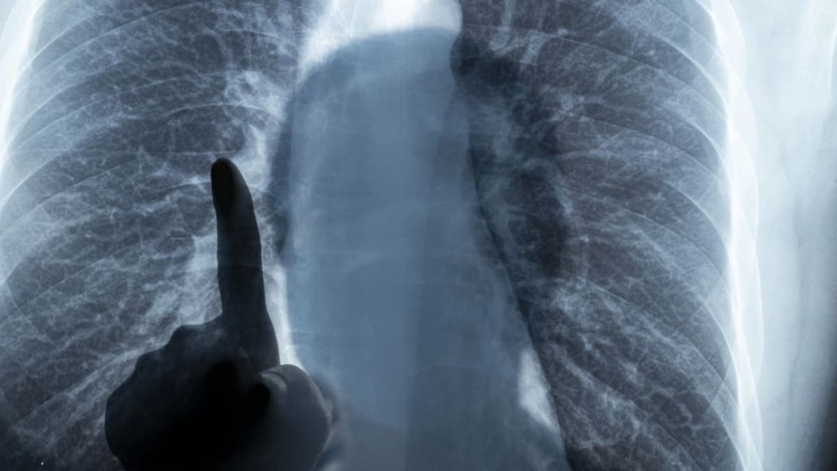 Descubren cómo las bacterias pueden desencadenar una forma de asma grave