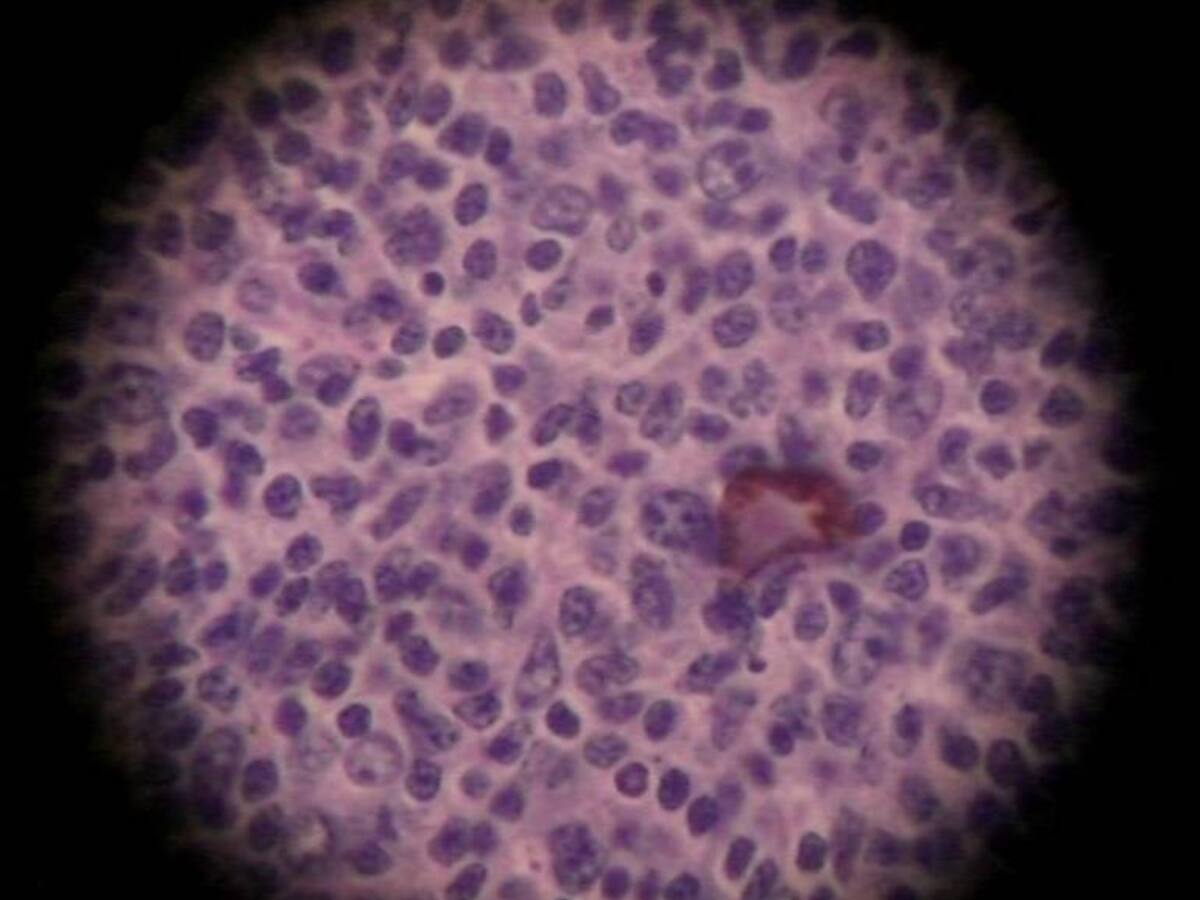 Cáncer, una enfermedad que está presente en todas las personas
