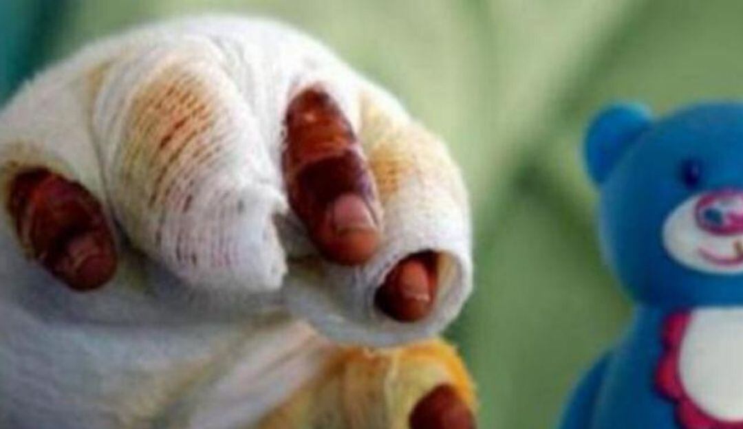 En una noche se duplicó la cifra de quemados con pólvora en Ibagué