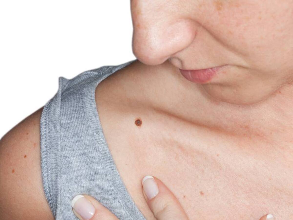 En 30% ha aumentado la mortalidad por melanoma en Colombia