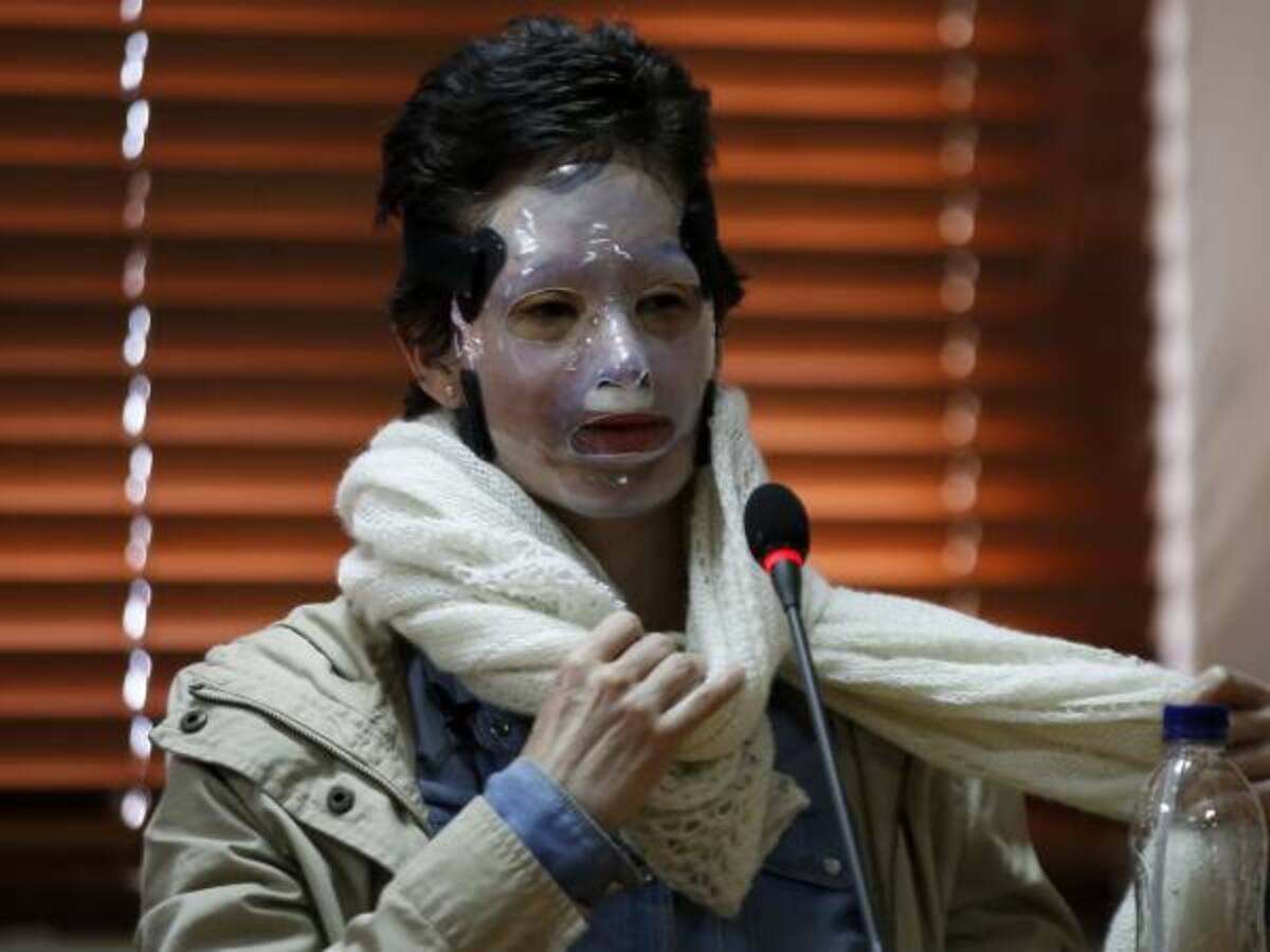 Gobierno propone plan piloto para atender a víctimas de ataque con ácido