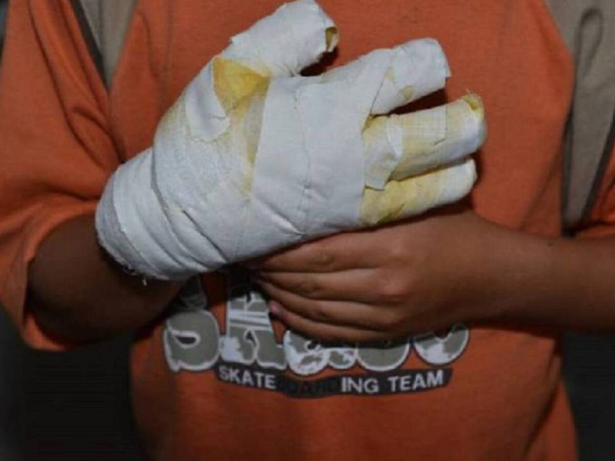Celebración de la navidad dejó 7 personas quemadas con pólvora en Antioquia