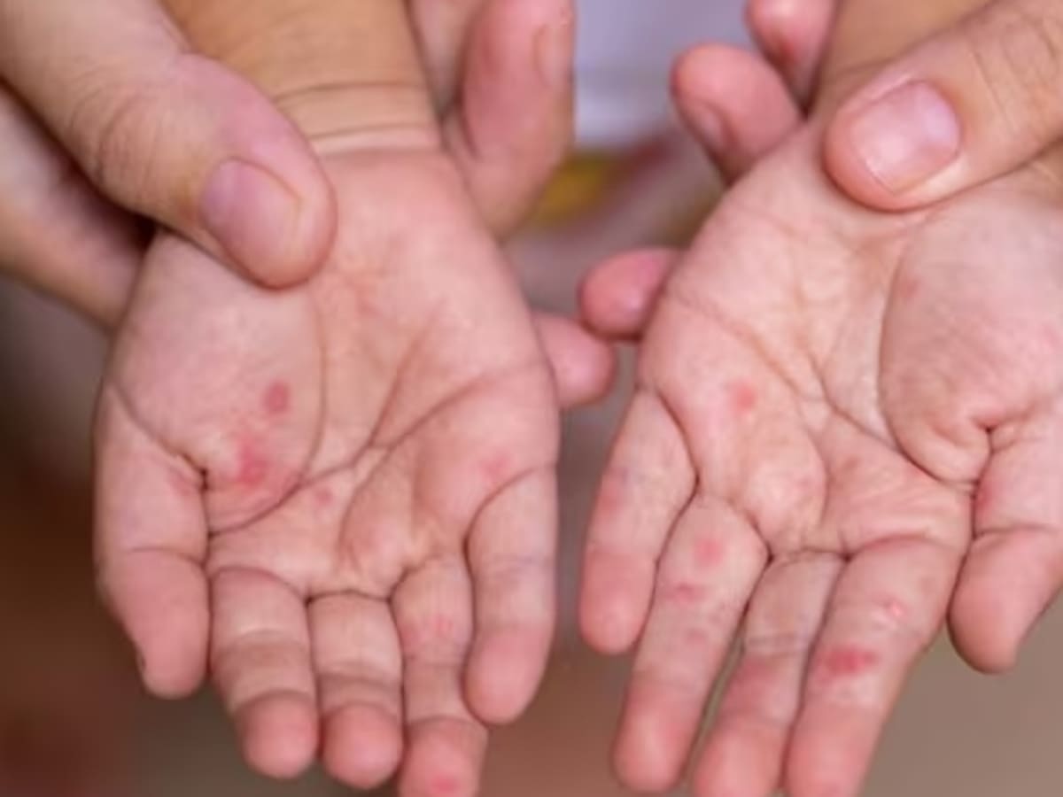 Persiste brote del síndrome de manos, pies y boca en Armenia, ya son 95 casos