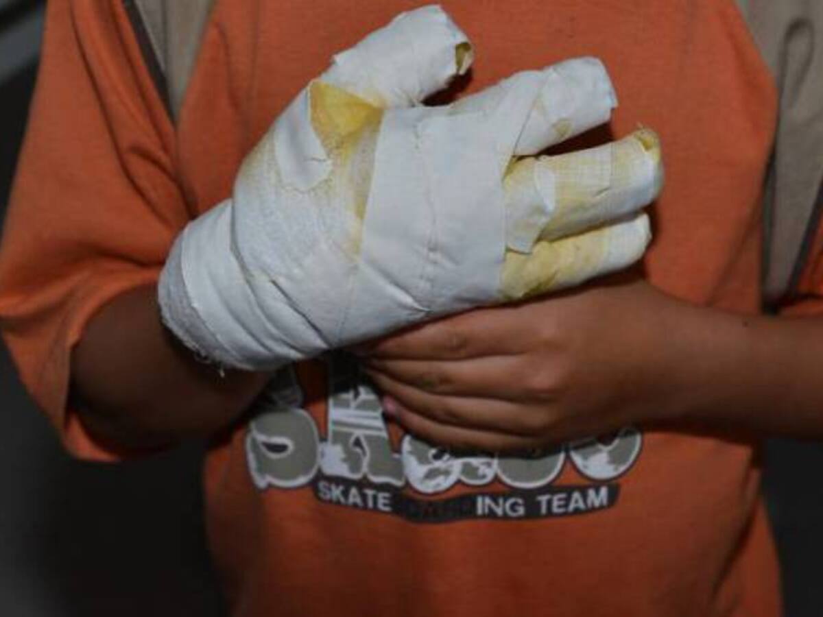 Tres menores de edad quemados con pólvora en Quindío durante fin de año