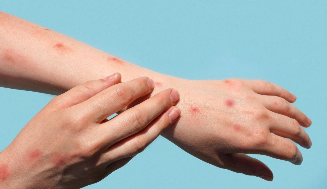 Viruela del mono. / Getty Images