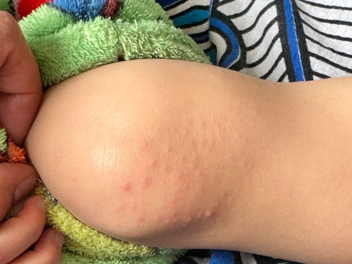 Boyacá reporta brotes de enfermedad de mano, pie y boca en niños