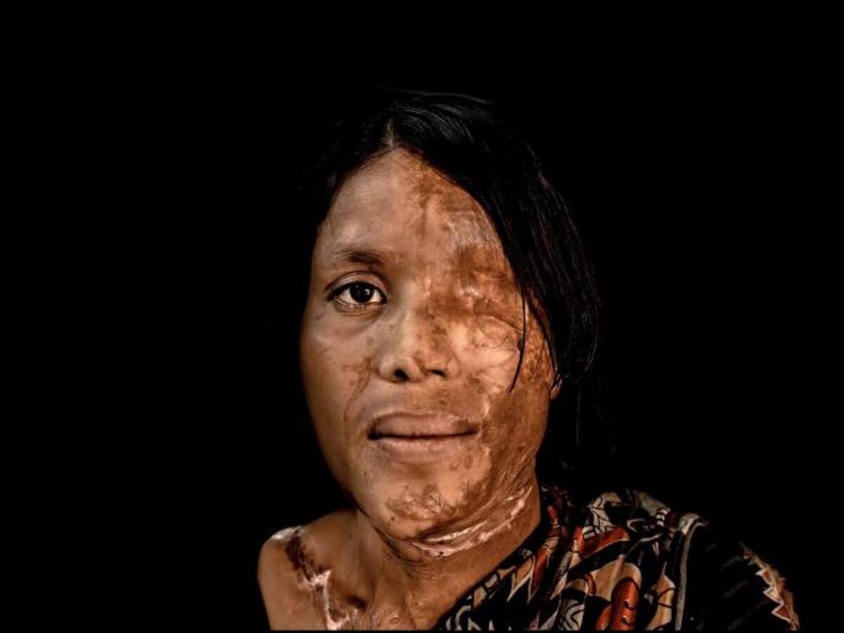 Qué hacer en caso de una quemadura