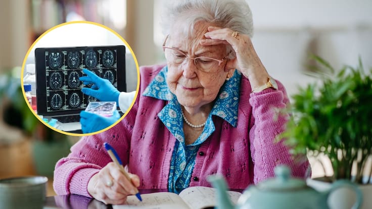 Con un simple pinchazo en el dedo: Xavier Morató explicó el avance para detectar el Alzheimer