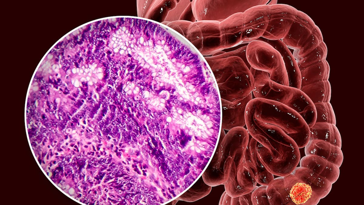 Los pacientes podrán vivir sin quimioterapia: doctor sobre posible nuevo tratamiento para tumores